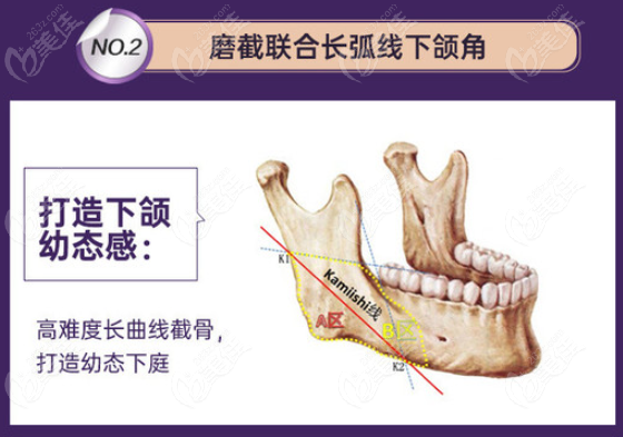 景氏風格下頜角磨骨和削骨有啥區(qū)別