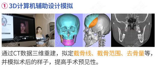 广州广大医院正颌手术怎么样