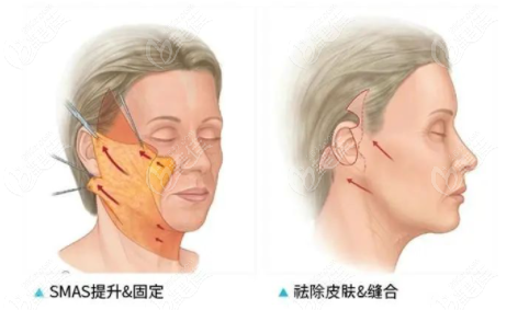 拉皮手術(shù)能做幾次呢