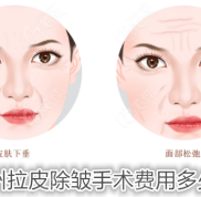 常州拉皮除皺手術(shù)費用多少錢