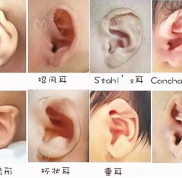 河南鄭州兒童耳畸形整形醫(yī)院排名中小耳矯正修復(fù)做得好就屬它
