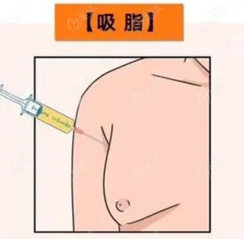 男性乳房肥大做抽脂手術(shù)會反彈嗎