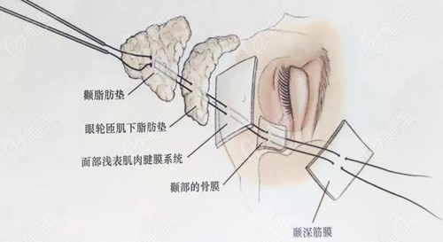 回答八爪魚面部提升術(shù)是怎么做的