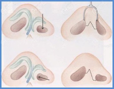 唇裂鼻畸形造成的鼻孔不對稱可以修復(fù)