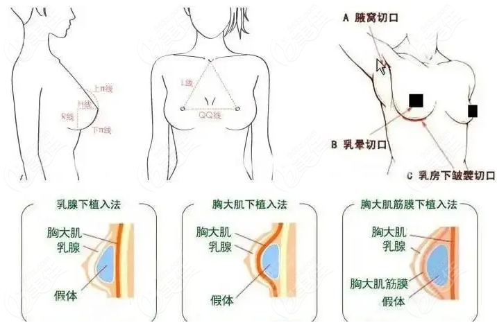 成都華美紫馨隆胸醫(yī)生名單