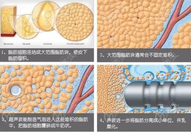 3分鐘了解維密脂雕和黃金微雕吸脂哪個(gè)好