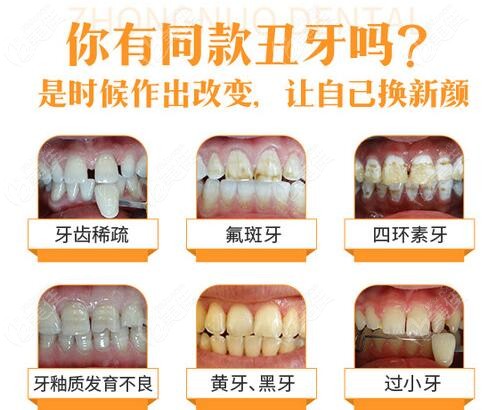 瑞典Procera全瓷牙價(jià)格是多少