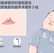 南京唇裂修復好的醫(yī)院醫(yī)生公布南京兔唇修復手術要多少錢