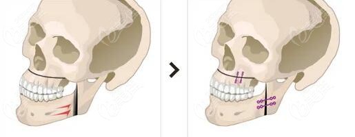 正颌术后多久拆钛板好