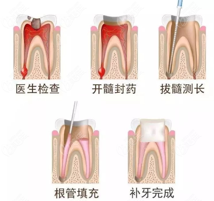 解答牙髓炎怎么治疗比较有效及治疗的费用大概是多少钱