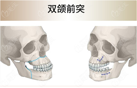 微创正颌手术是什么呢