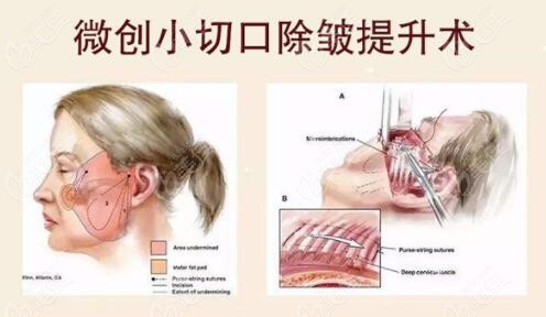 過(guò)來(lái)人告訴你做完拉皮手術(shù)后頭套每天需要戴幾個(gè)小時(shí)