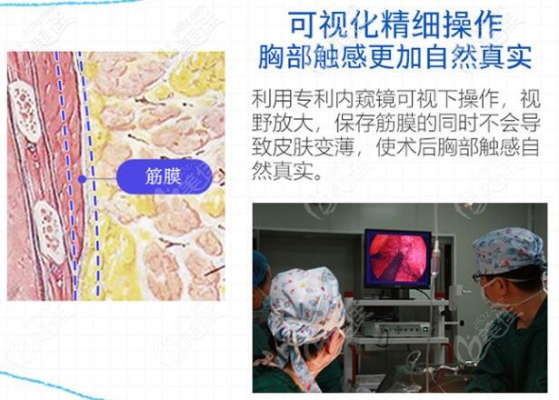 杭州格莱美整形医院做丰胸用3D内窥镜