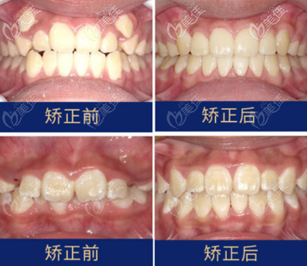 常見牙套的全部種類和價格及圖片