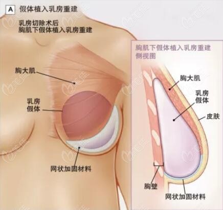 做乳房重建用假體好還是自體好