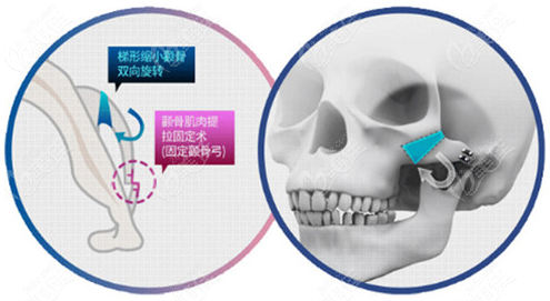 上海顴骨內(nèi)推哪個(gè)醫(yī)生好呢