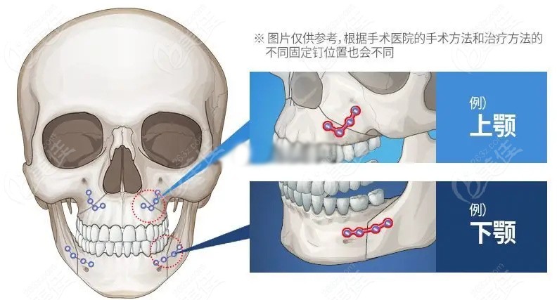 小正颌和大正颌的区别不仅仅是费用不同