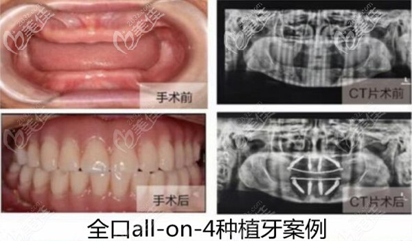北京维乐口腔种植牙的价格是多少钱