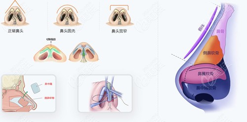 摸清強(qiáng)生瑆珀超肋假體的優(yōu)點(diǎn)和缺點(diǎn)