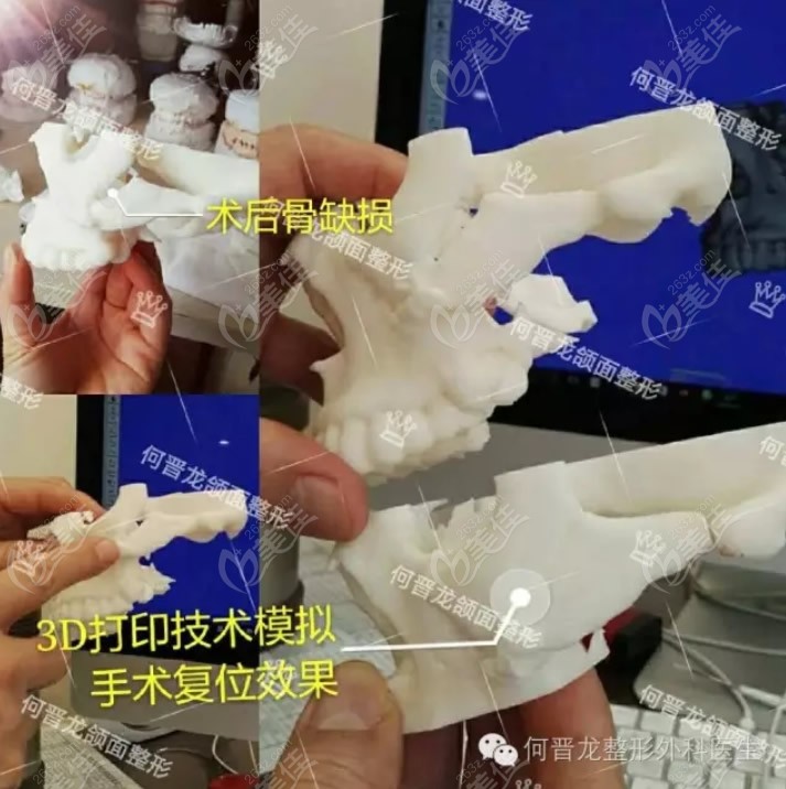 上海何晋龙医生3D打印修复下颌角和颧骨颧弓的收费标准