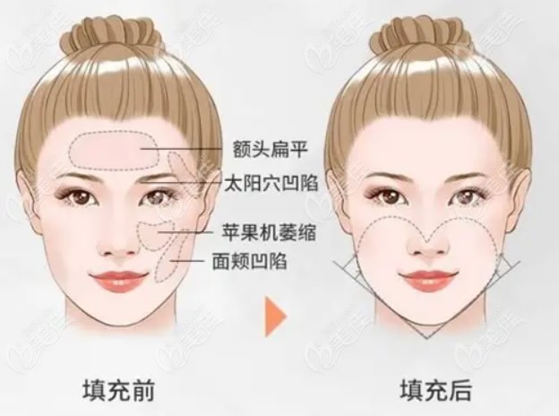 上海华美医院全脸脂肪填充价格大概多少钱和哪个医生做手术有很大关系