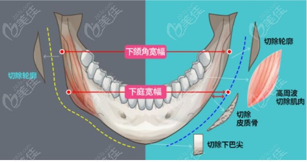 上海做下頜角哪個醫(yī)生好