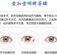 合肥壹加壹甘泉涌院长割双眼皮技术怎样