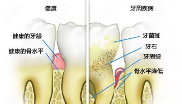 牙周炎不及時治療