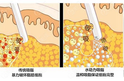 河南濮阳哪家医院可以做抽脂减肥