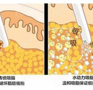 河南濮陽哪家醫(yī)院可以做抽脂減肥