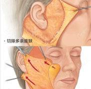 濟(jì)南哪個(gè)醫(yī)院做拉皮做的好
