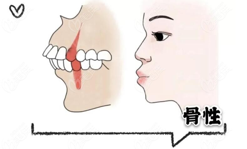 那些很后悔做骨性齙牙正畸的朋友來看下我骨性齙牙矯正前后外貌變化有多大