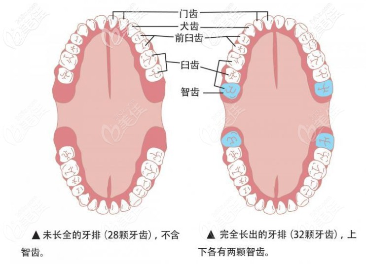 一次性拔4顆智齒會有危險嗎