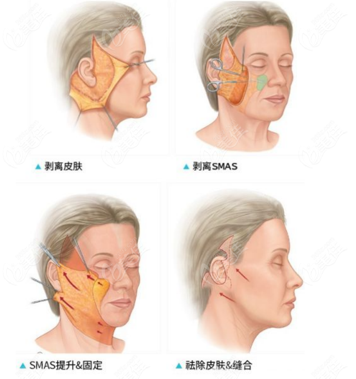 國內(nèi)smas筋膜提升術(shù)哪個醫(yī)生厲害