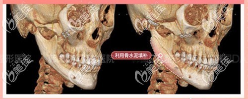 从韩国DA的下颌角凹陷失败修复案例就能看出