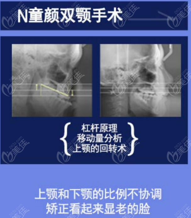 这一份韩国凸嘴手术医院排名约等于是韩国正颌手术医院排名哦