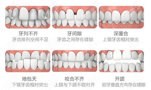 在晋江市修大夫口腔做金属托槽牙齿矫正费用贵不贵