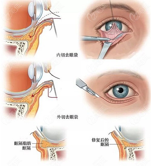 焦作哪里有做眼袋