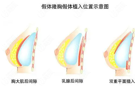 10分、15分、20分钟急速隆胸好不好