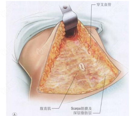 腹壁整形術(shù)到底有多痛呀