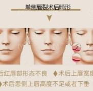 據(jù)說昆明做兒童唇腭裂修復(fù)手術(shù)和二期兔唇矯正比較好的醫(yī)院是它們