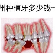 貴州種植牙多少錢一顆