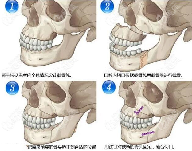 重庆地包天手术做得好的医院医生展示