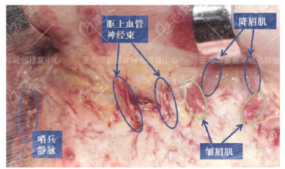 高位smas筋膜提升可以保持幾年和手術(shù)恢復(fù)期是多久同時(shí)解析