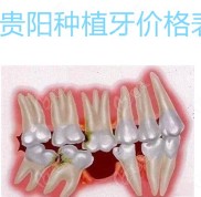 貴陽種植牙價格表更新