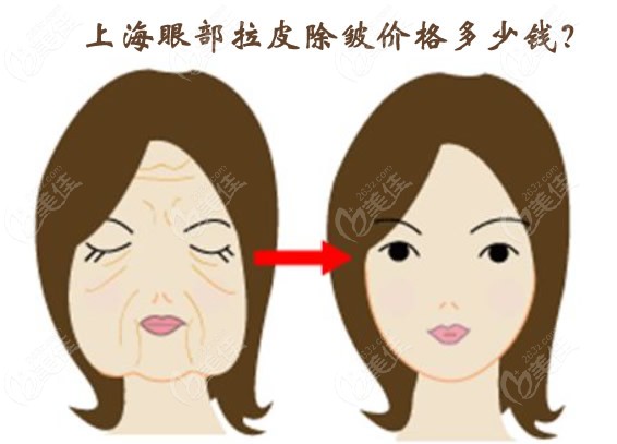 上海眼部拉皮除皱手术的价格是多少
