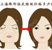上海眼部拉皮除皺手術(shù)的價(jià)格是多少