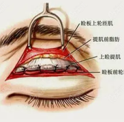 長沙藝星做眼睛好的醫(yī)生周芳做美杜莎綜合美眼不錯(cuò)