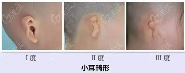 郑州赵绛波耳再造收费标准由郑州做耳畸形手术好的医院(河南中医一附院)提供