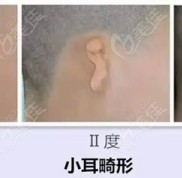 鄭州趙絳波耳再造收費標(biāo)準(zhǔn)由鄭州做耳畸形手術(shù)好的醫(yī)院(河南中醫(yī)